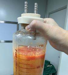 湖州水动力吸脂手术要做多久？